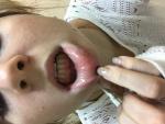 Потертость внутри губы и мелкие прыщечки фото 2