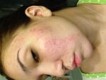 Сильные высыпания на лице, похожие на аллергию, ярко-розовый цвет фото 3