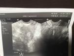 Анэхогенное образование 2 мм в полости матки фото 2