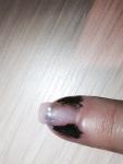 Опух палец после удаления бородавки лазером фото 1