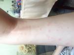 Сыпь по всей ноге в виде комариных укусов фото 2