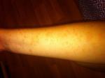 Аллергия после татуировки фото 1