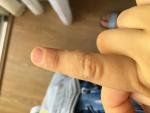 Волдыри и наросты на пальцах у ребенка фото 2