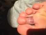 Ушиб указательного пальца ноги фото 3