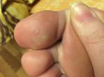 Непонятные пятна на большом пальце ноги (снизу) фото 1