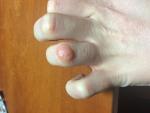 Болячки на суставах пальцев фото 2