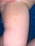 Ребёнку 2 года, появилась аллергия, раньше с этим не сталкивались , пер фото 1
