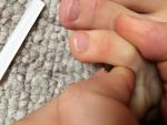 Грибок (белые прожилки) на отрастающей части ногтей фото 1
