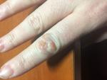 Болячки на суставах пальцев фото 3