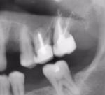 Боль в зубе после депульпирования фото 1
