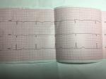 ЭКГ расшифровка, боли в сердце, учащенное сердцебиение фото 2