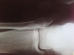 Перелом малоберцовой и большеберовой примерно фото 3