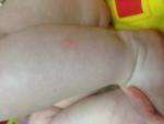 Сыпь и сухие пятна у грудного ребёнка +фото фото 4