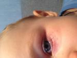 Красные точки вокруг глаз, на носу, возле рта ребёнка 1,11г фото 1