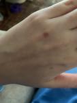 Фиолетовое пятно на руке фото 1