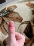 Что делать, при отсутствии ногтя с покраснениями? фото 1