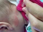 Сыпь у ребенка после введения прикорма фото 1