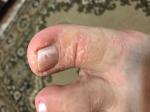 Розовые шелушащиеся пятна на коже ног фото 2