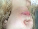 Себорейный дерматит на лице и голове фото 2