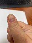 Воспаление кожи возле ногтя фото 2