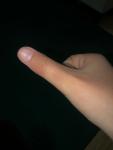 Травма великого пальця фото 1