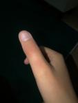 Травма великого пальця руки фото 1