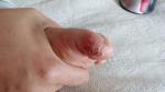 Сильно слазит кожа на пальцах ног ребенка фото 2