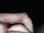 Образования между пальцами ног фото 1