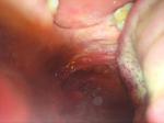 Ком в горле и увеличены лимфатические узлы за ушами фото 3