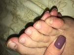 Бурое пятно на ногте большого пальца ноги фото 2