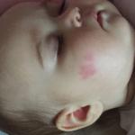 Красное пятно с уплотнением на лице у ребенка фото 3