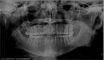 Белое пятно на рентгене челюстного сустава фото 1