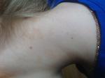 Пигментные пятна на шее у ребенка фото 2