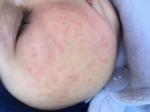 Папулезный высыпания на щеках ребёнка 8 месяцев фото 1