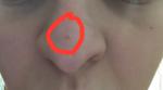 Красная точка на носу фото 2