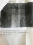 Дисплазия тбс рентген фото 1