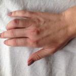 Травма сухожилия глубокого сгибателя, не разгибается палец фото 2