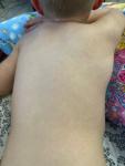 Сыпь у ребенка без симптомов фото 1
