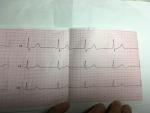 ЭКГ расшифровка, боли в сердце, учащенное сердцебиение фото 4