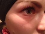 Алергия под глазом фото 1