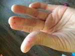 Шелушение большого и среднего пальцев руки, трещины фото 2