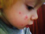 Прыщики на лице у ребенка не проходят 3 месяца фото 2