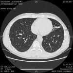 Бронхиальная астма и пневмофиброз. Снимки фото 2