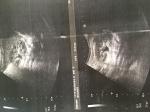 Двухстороння Пиелоэктазия у грудничка 7 месяцев фото 5