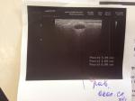 Подозрение на кисту околоушной слюнной железы справа фото 1