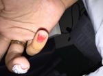 Обработка раны после удаления ногтевой пластины фото 1