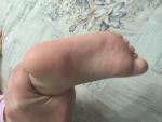 Сыпь на ступнях у ребенка фото 1