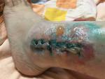 Волдыри возле раны после операции на голеностопе фото 2