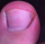 Можно ли самостоятельно удалить вросший ноготь средством ногтивит? фото 2