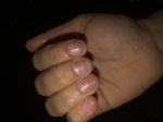 Грибок ногтей рук фото 3
